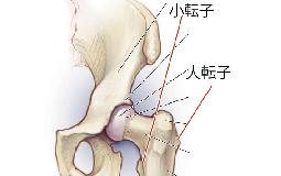 股関節がパキパキ音がなる（弾発股）