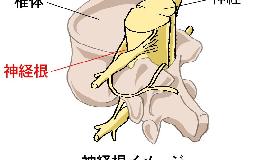 手が痺れる（神経根症状）